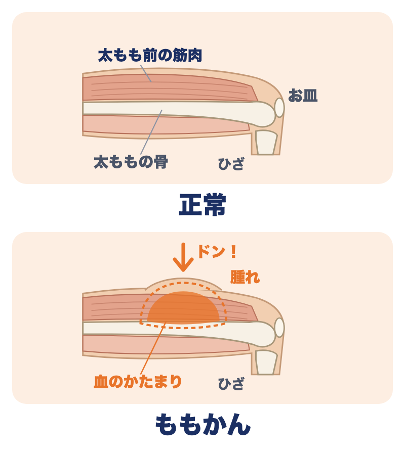 大腿部打撲（ももかん）：正常な太もも（筋肉が骨をおおっている）と、ももかん（ぶつかった所の奥で出血し、血のかたまりができる）を並べた図
