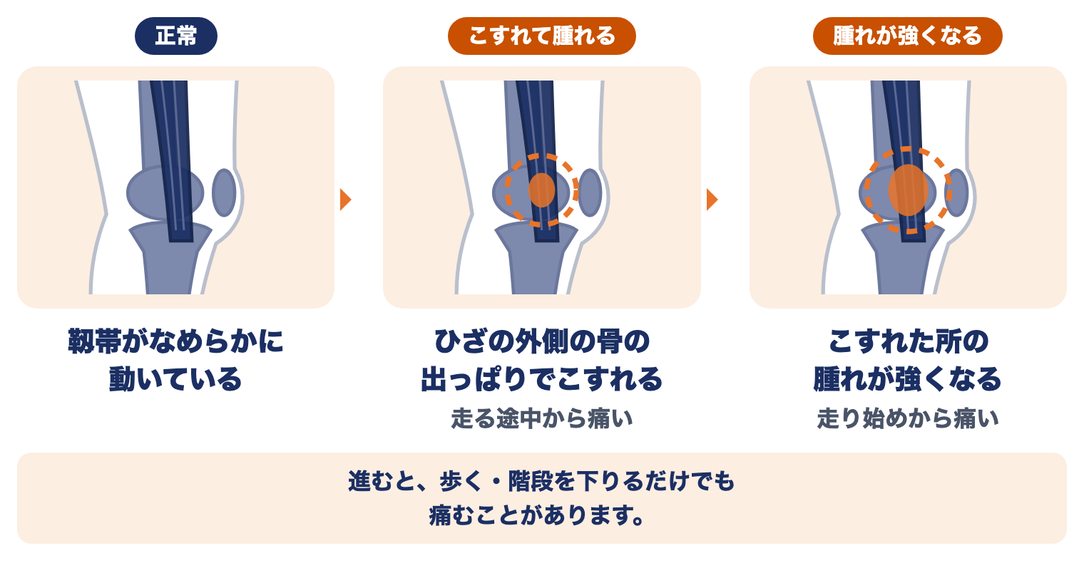 ランナー膝の進み方：正常、ひざの外側の骨の出っぱりでこすれて腫れる（走る途中から痛い）、腫れが強くなる（走り始めから痛い）
