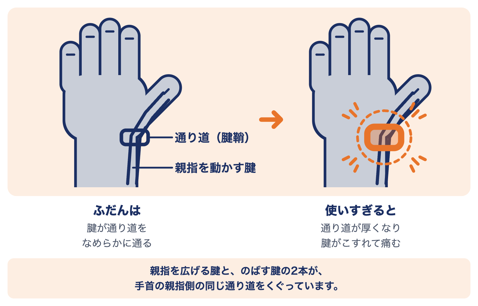 ドケルバン病の仕組み：親指を動かす腱が手首の通り道（腱鞘）を通る。使いすぎると通り道が厚くなり、腱がこすれて痛む