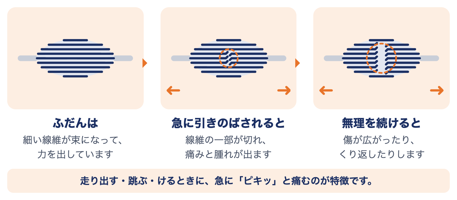 肉離れで筋肉に起きていること：ふだんは線維が束になって力を出す、急に引きのばされると一部が切れる、無理を続けると傷が広がる
