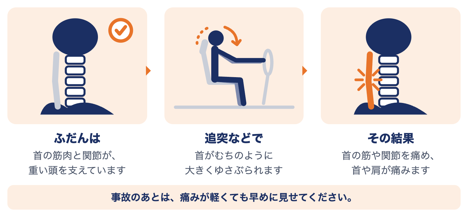 むち打ちで首に起きていること：ふだんは首の筋肉と関節が頭を支え、追突などで首が大きくゆさぶられ、首の筋や関節を痛める