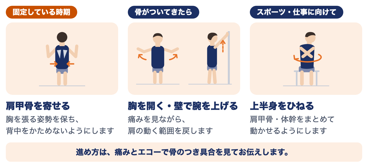 鎖骨骨折の時期別の運動療法：固定している時期は肩甲骨を寄せる、骨がついてきたら胸を開く・壁で腕を上げる、スポーツ・仕事に向けて上半身をひねる