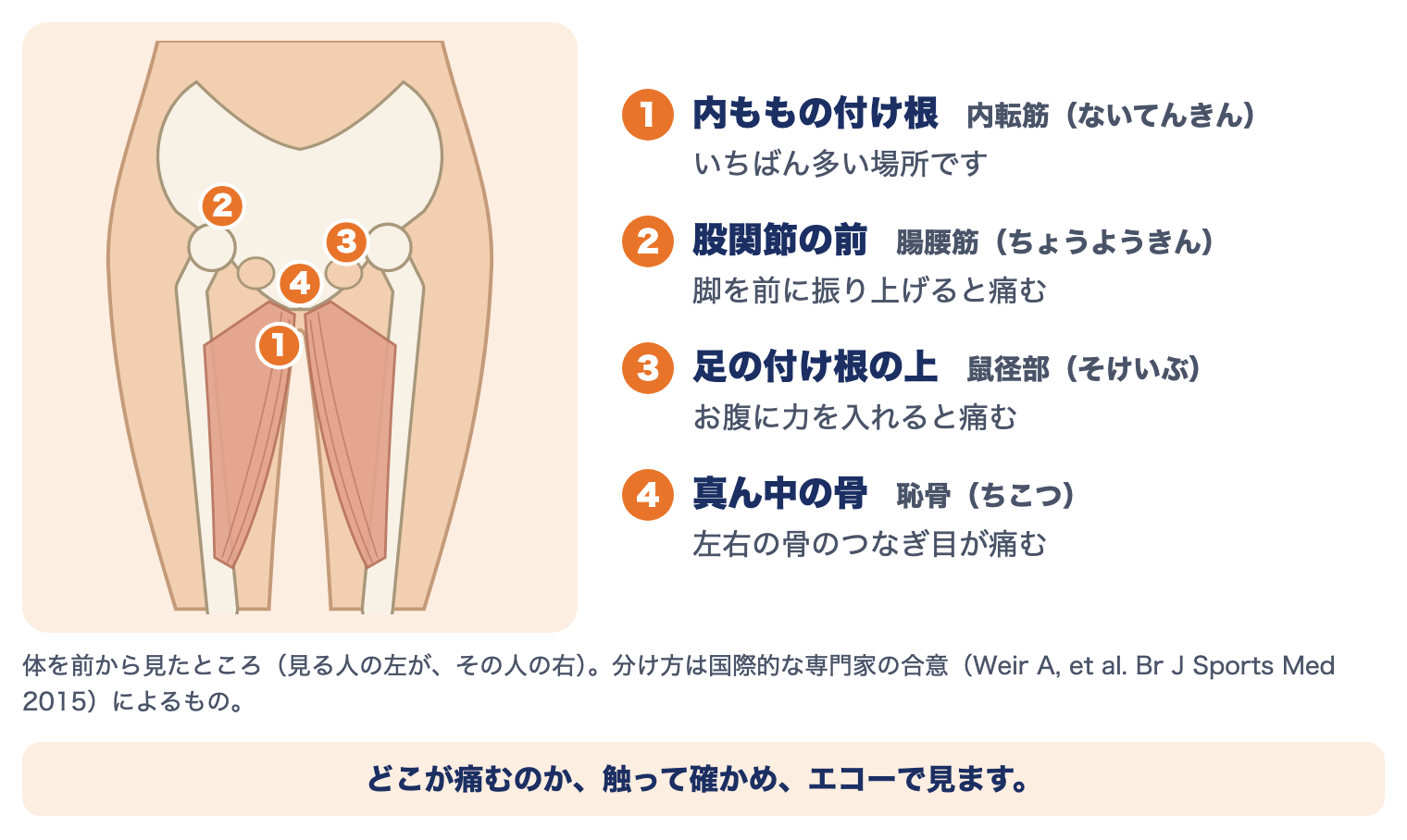 グローインペイン症候群の痛む場所4つ：①内ももの付け根（内転筋）②股関節の前（腸腰筋）③足の付け根の上（鼠径部）④真ん中の骨（恥骨）