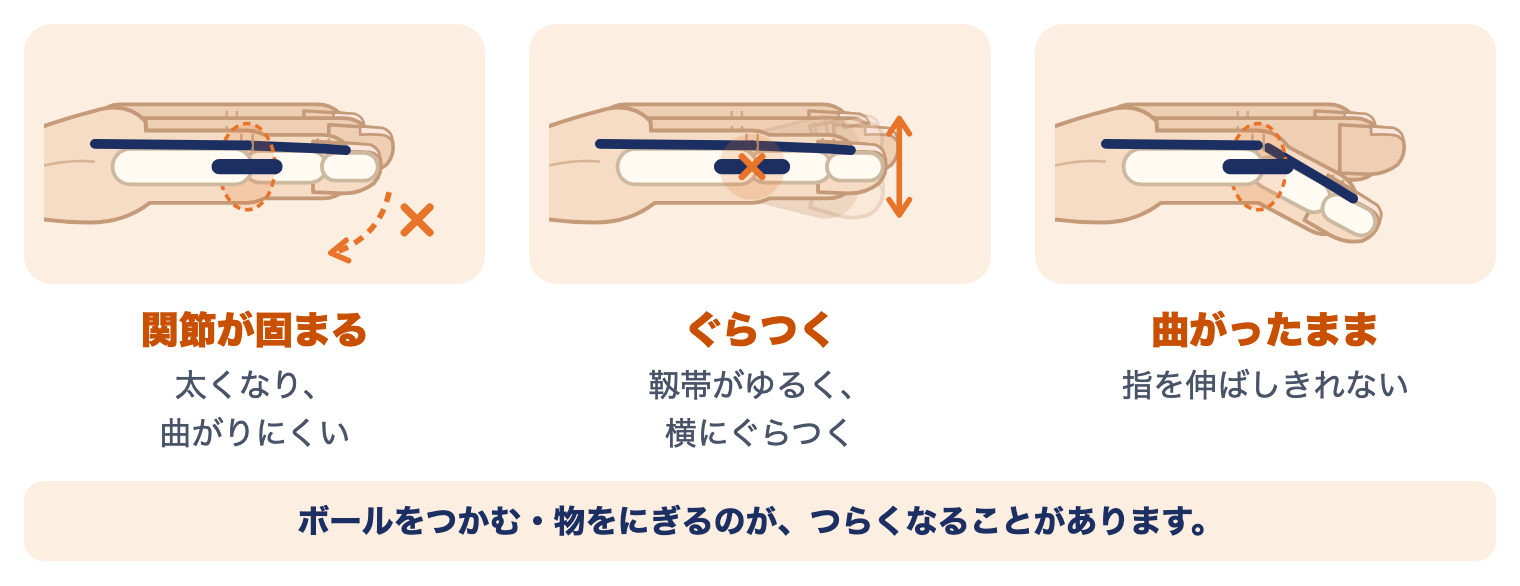 指の脱臼のあとに残りやすいこと：関節が固まる、横にぐらつく、指が曲がったままになる