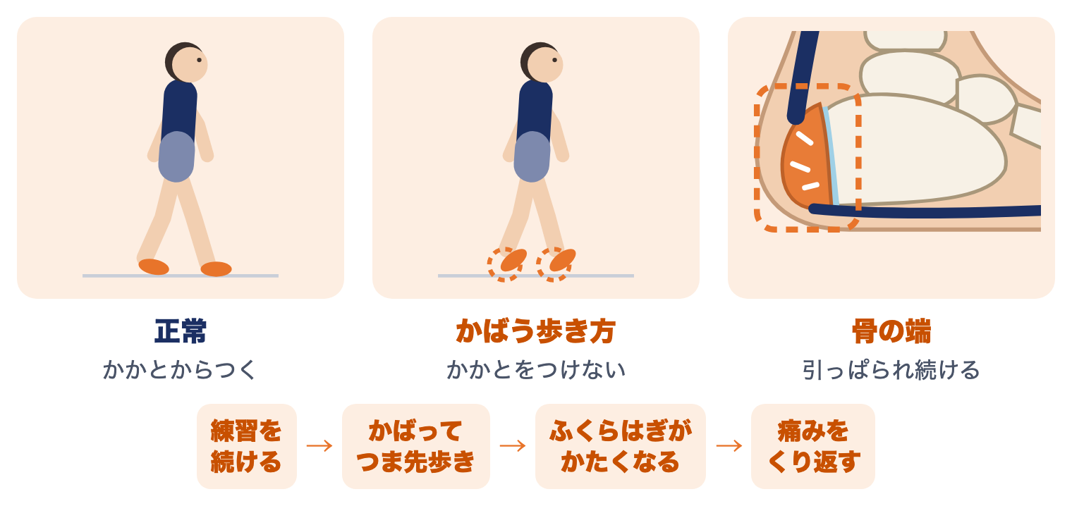 シーバー病を放っておくと：かかとからつく正常な歩き方、かかとをつけないかばう歩き方、引っぱられ続けるかかとの骨の端の絵と、練習を続ける・つま先歩き・ふくらはぎがかたくなる・痛みをくり返すという流れ