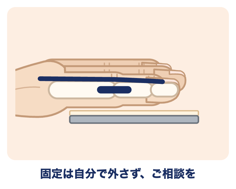 突き指の固定（そえ木）は自分で外さず、ご相談ください