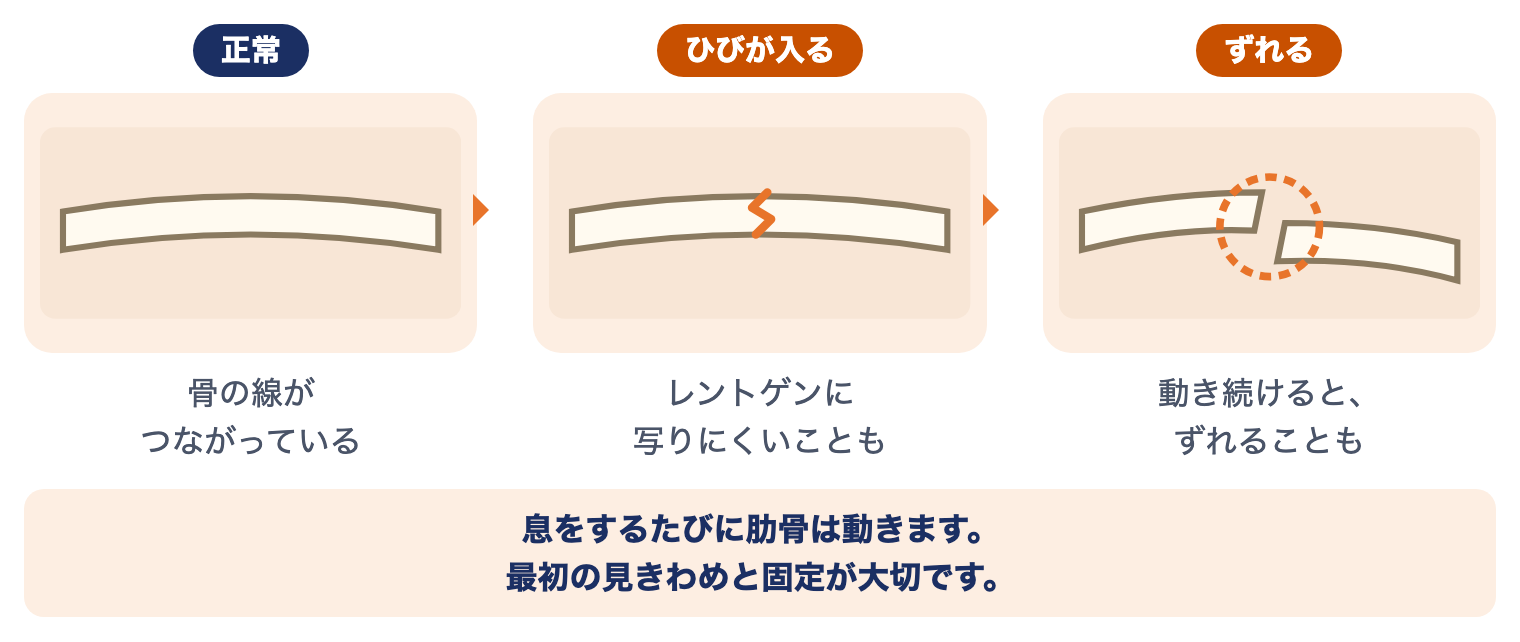 肋骨骨折の3つの状態：正常な肋骨、ひびが入った肋骨（レントゲンに写りにくい）、ずれた肋骨