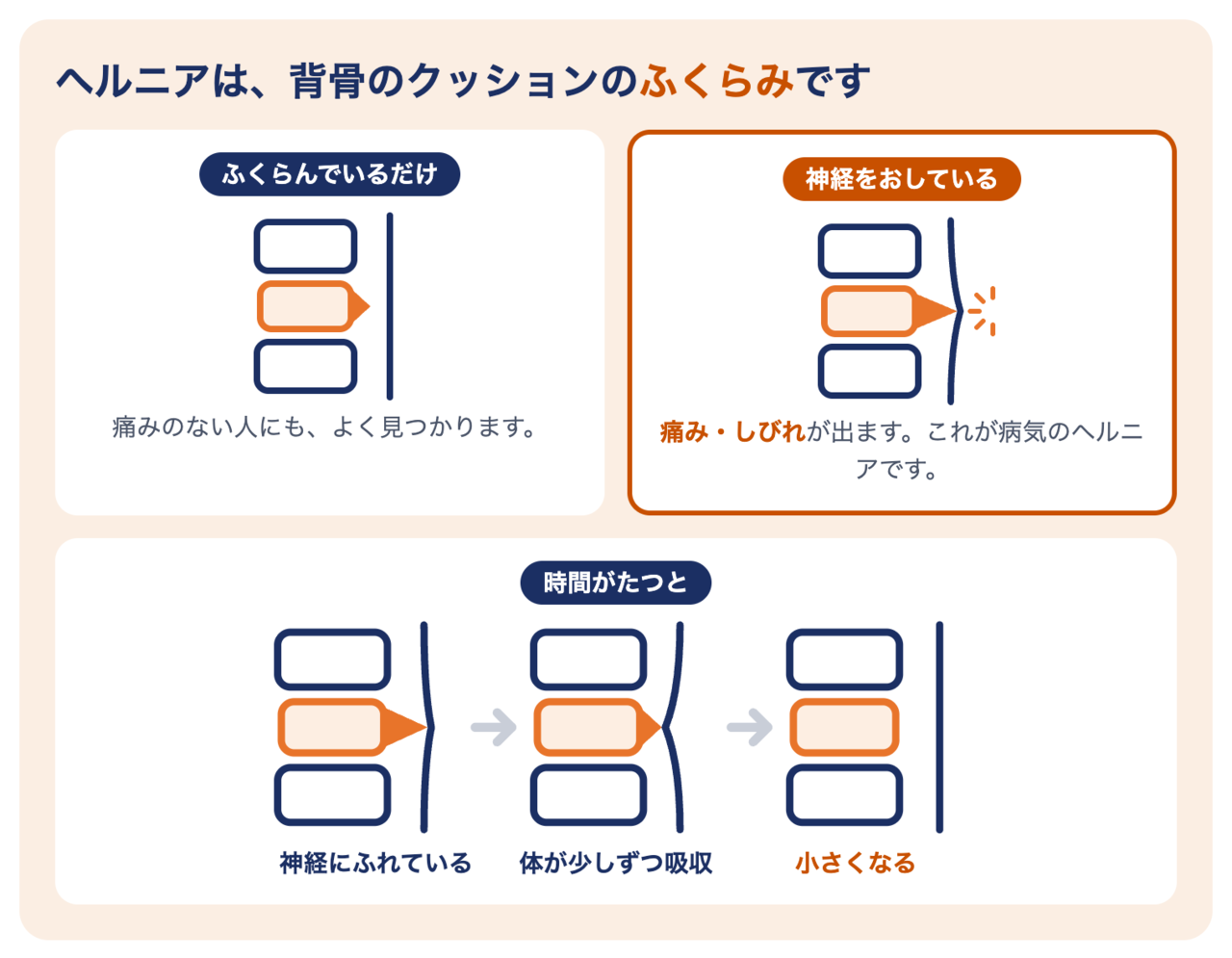 腰椎椎間板ヘルニアのしくみ：椎間板がふくらんでいるだけの状態と、神経をおして痛み・しびれが出る状態。時間がたつと吸収されて小さくなる