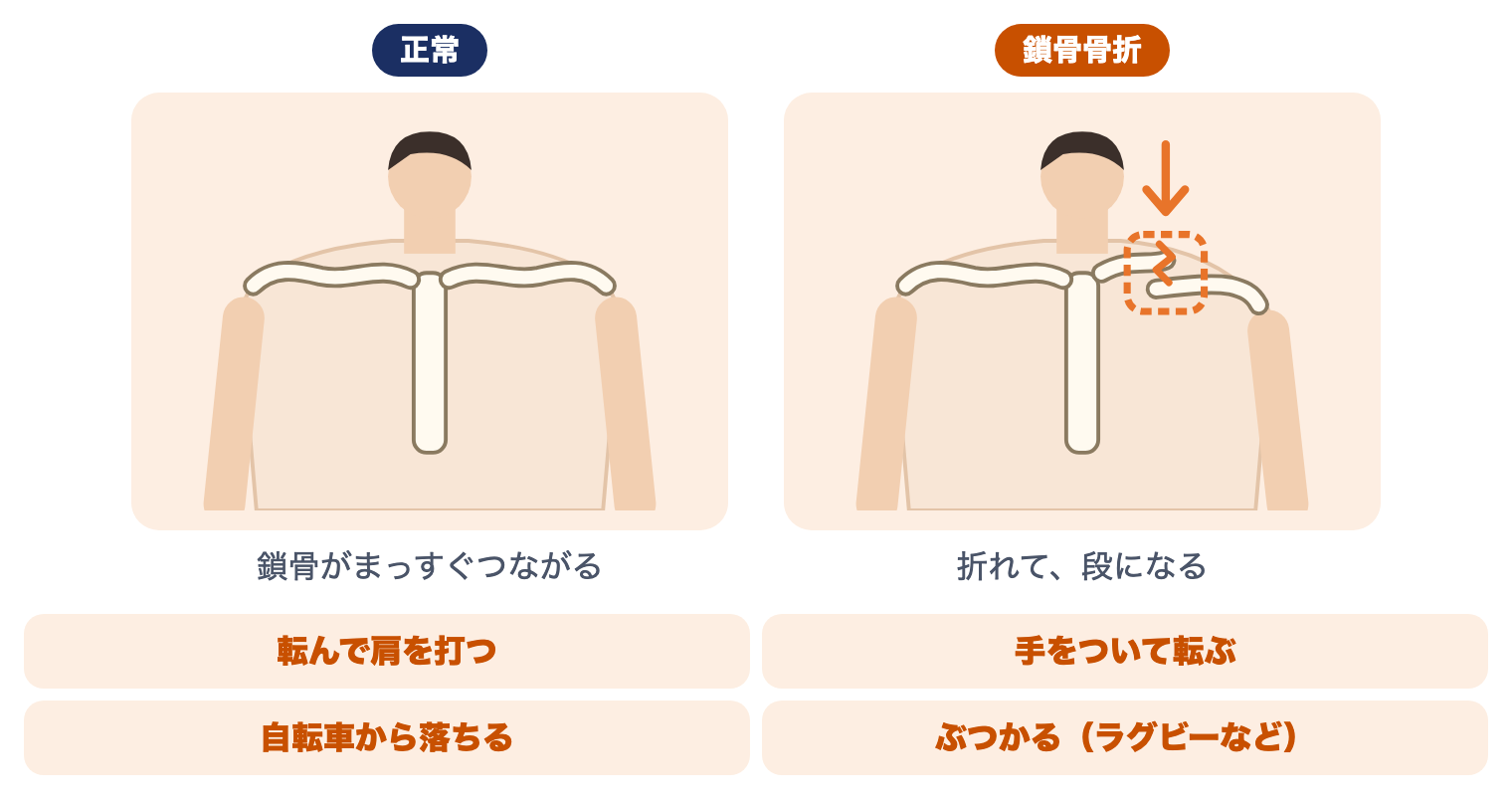 鎖骨骨折の正常と骨折の比べ：正常は鎖骨がまっすぐつながり、骨折では折れて段になる。転んで肩を打つ・手をついて転ぶ・自転車から落ちる・ぶつかるなどで起こる