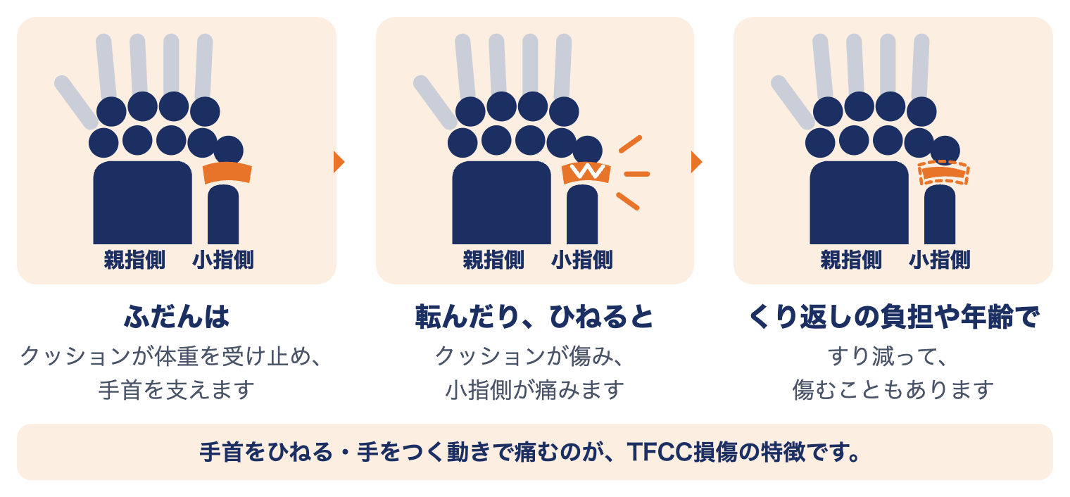 TFCC損傷で手首の小指側に起きていること：ふだんはクッションが体重を受け止め、転んだりひねったりすると傷み、くり返しの負担や年齢ですり減ることもある