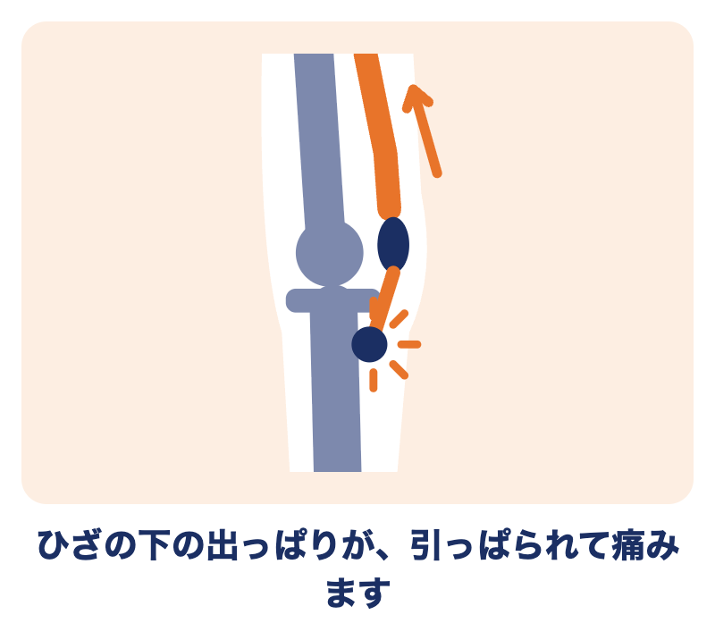 オスグッド病：太ももの前の筋肉が、ひざの下の出っぱり（脛骨粗面）を引っぱって痛むしくみのイラスト
