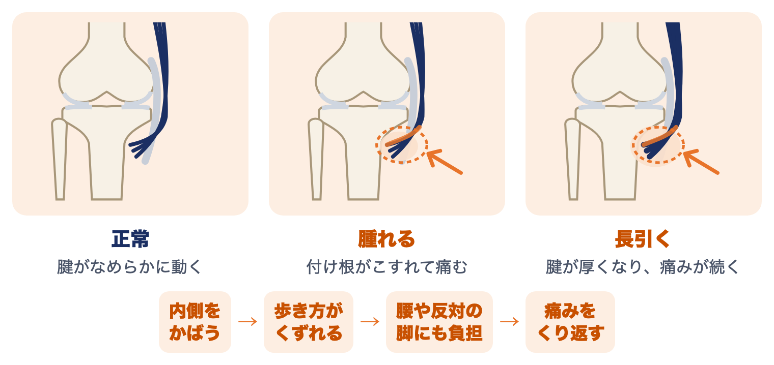 鵞足部の痛みを放っておくと：腱がなめらかに動く正常、付け根がこすれて腫れる、腱が厚くなり痛みが続くの3段階と、内側をかばう・歩き方がくずれる・腰や反対の脚にも負担・痛みをくり返すという流れ