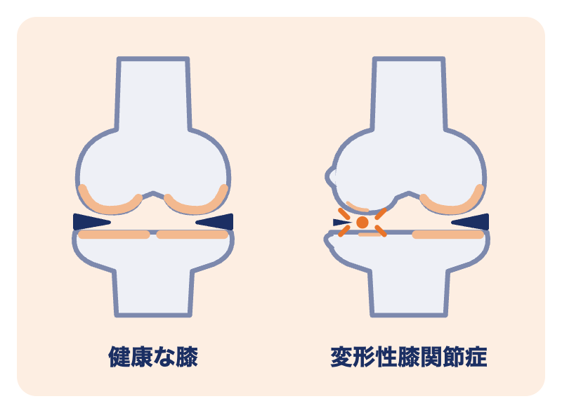 変形性膝関節症のイラスト：健康な膝と比べて、膝の内側の軟骨がすり減り、骨と骨のすき間がせまくなっている