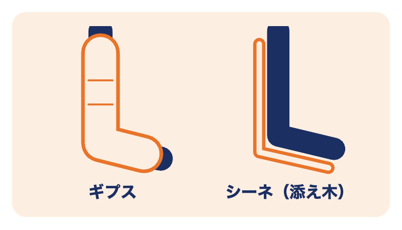 外果骨折の施術で使う固定：ギプスとシーネ（添え木）