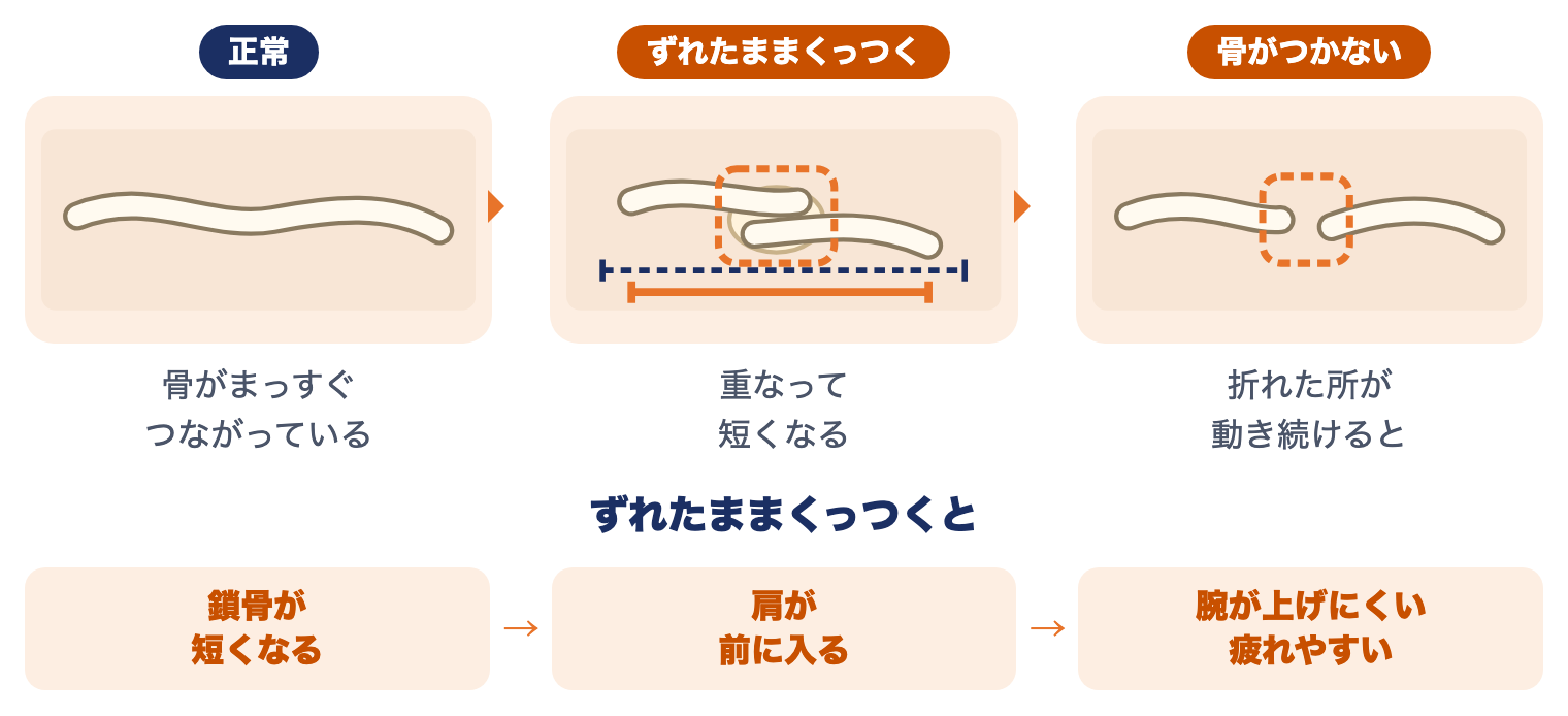 鎖骨骨折の3つの状態：正常な鎖骨、ずれたまま重なって短くくっついた鎖骨、骨がつかない鎖骨。ずれたままくっつくと、鎖骨が短くなり、肩が前に入り、腕が上げにくくなる