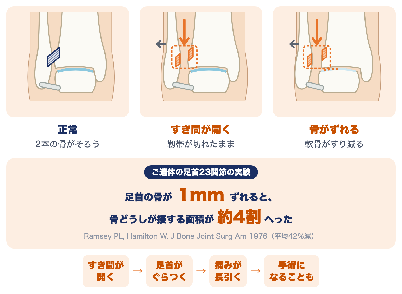 前脛腓靱帯損傷を放っておくと：正常、すき間が開く、足首の骨がずれて軟骨がすり減る絵と、足首の骨が1mmずれると接する面積が約4割へった実験、すき間が開く・ぐらつく・痛みが長引く・手術になることもという流れ