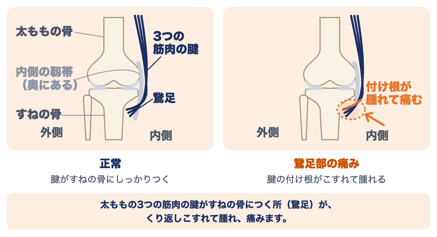 鵞足炎（鵞足部の痛み）の痛む場所：右ひざを前から見た骨の絵で、正常なひざと、太ももの3つの筋肉の腱の付け根（鵞足）がこすれて腫れ、痛む所