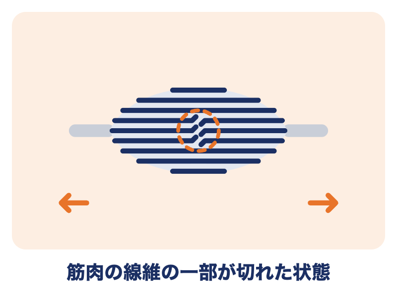 肉離れとは：筋肉の線維の一部が切れた状態