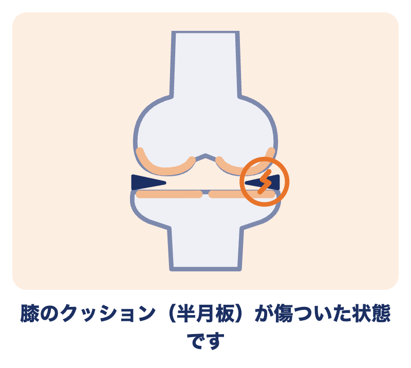 半月板損傷のイラスト：膝の骨と骨の間にあるクッション（半月板）に傷がついている