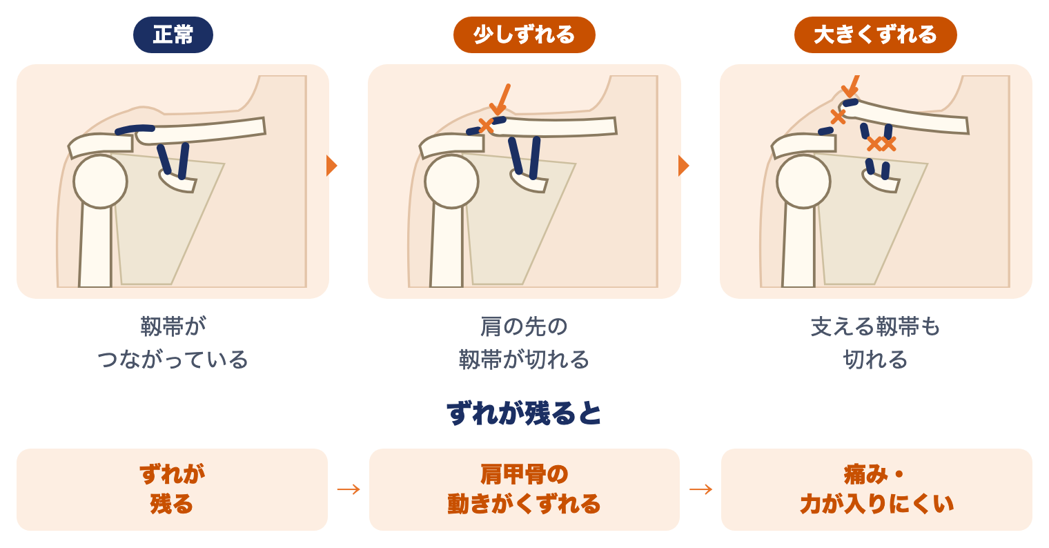 肩鎖関節脱臼の3つの状態：正常、肩の先の靱帯が切れて少しずれる、支える靱帯も切れて大きくずれる。ずれが残ると肩甲骨の動きがくずれ、痛み・力が入りにくいことがある