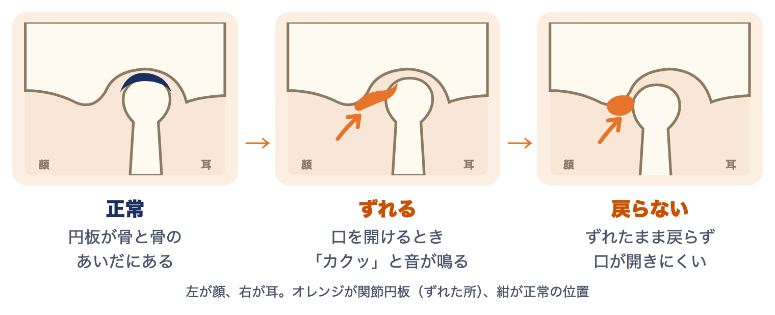 顎関節症の関節円板のずれ方：正常は円板が骨のあいだにある、ずれると口を開けるときに音が鳴る、戻らないと口が開きにくくなる