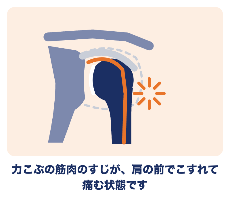 上腕二頭筋長頭腱炎の肩：力こぶの筋肉のすじが、肩の前でこすれて痛む状態