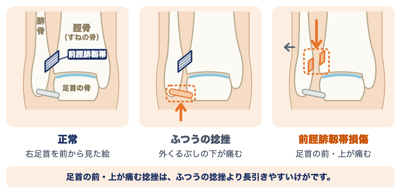 前脛腓靱帯損傷とふつうの足首の捻挫のちがい：右足首を前から見た絵で、正常、外くるぶしの下が痛むふつうの捻挫、足首の前・上が痛む前脛腓靱帯損傷