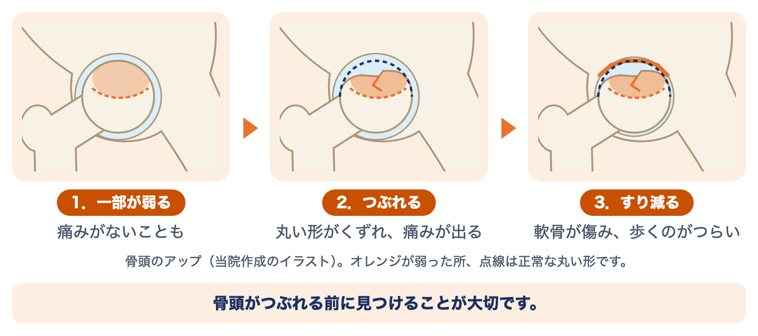 特発性大腿骨頭壊死症の進み方：骨頭の一部が弱る（痛みがないことも）、つぶれる（丸い形がくずれ痛みが出る）、すり減る（軟骨が傷み歩くのがつらい）