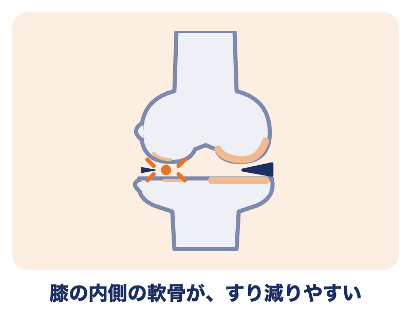 変形性膝関節症のイラスト：膝の内側の軟骨がすり減りやすい