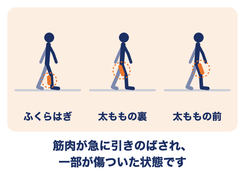 肉離れが起こりやすい場所：ふくらはぎ・太ももの裏・太ももの前。筋肉が急に引きのばされ、一部が傷ついた状態