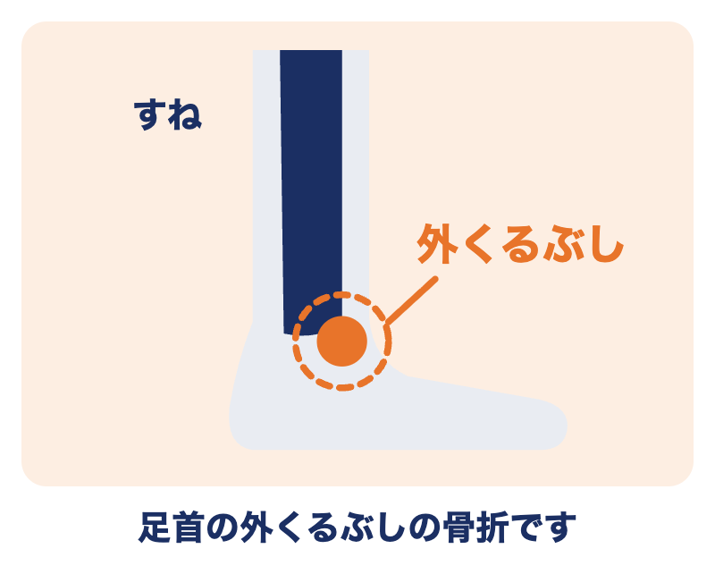 外果骨折の場所：足首の外側にある「外くるぶし」の骨折
