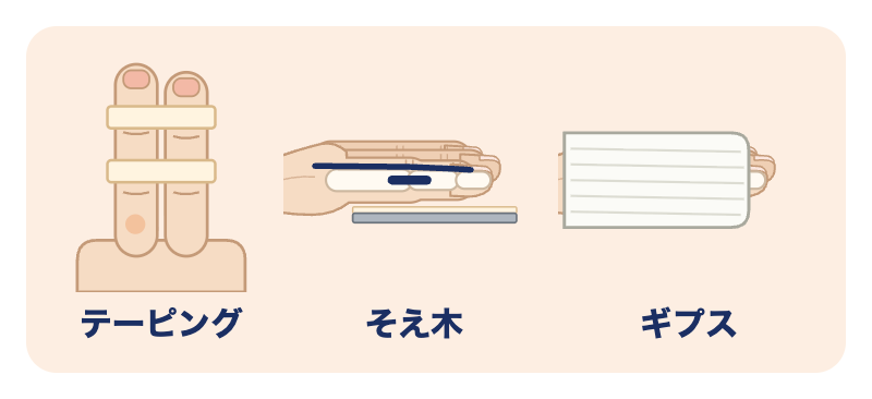 突き指の固定：隣の指と一緒にテーピング、そえ木、ギプス