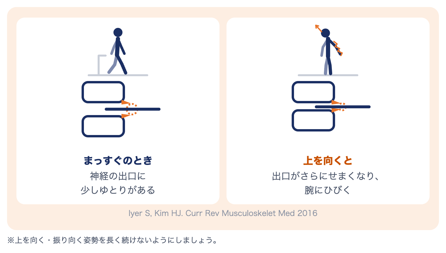 頚椎症性神経根症で上を向くと腕にひびく理由：首を後ろへ倒すと神経の出口がさらにせまくなる
