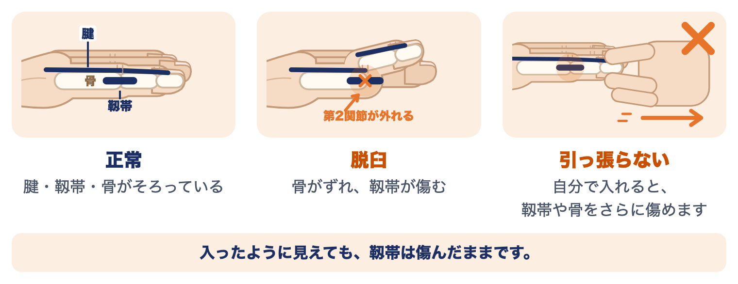 指の脱臼で指の中に起きていること：正常な指、第2関節が外れて靱帯が傷んだ指、引っ張って入れてはいけないこと