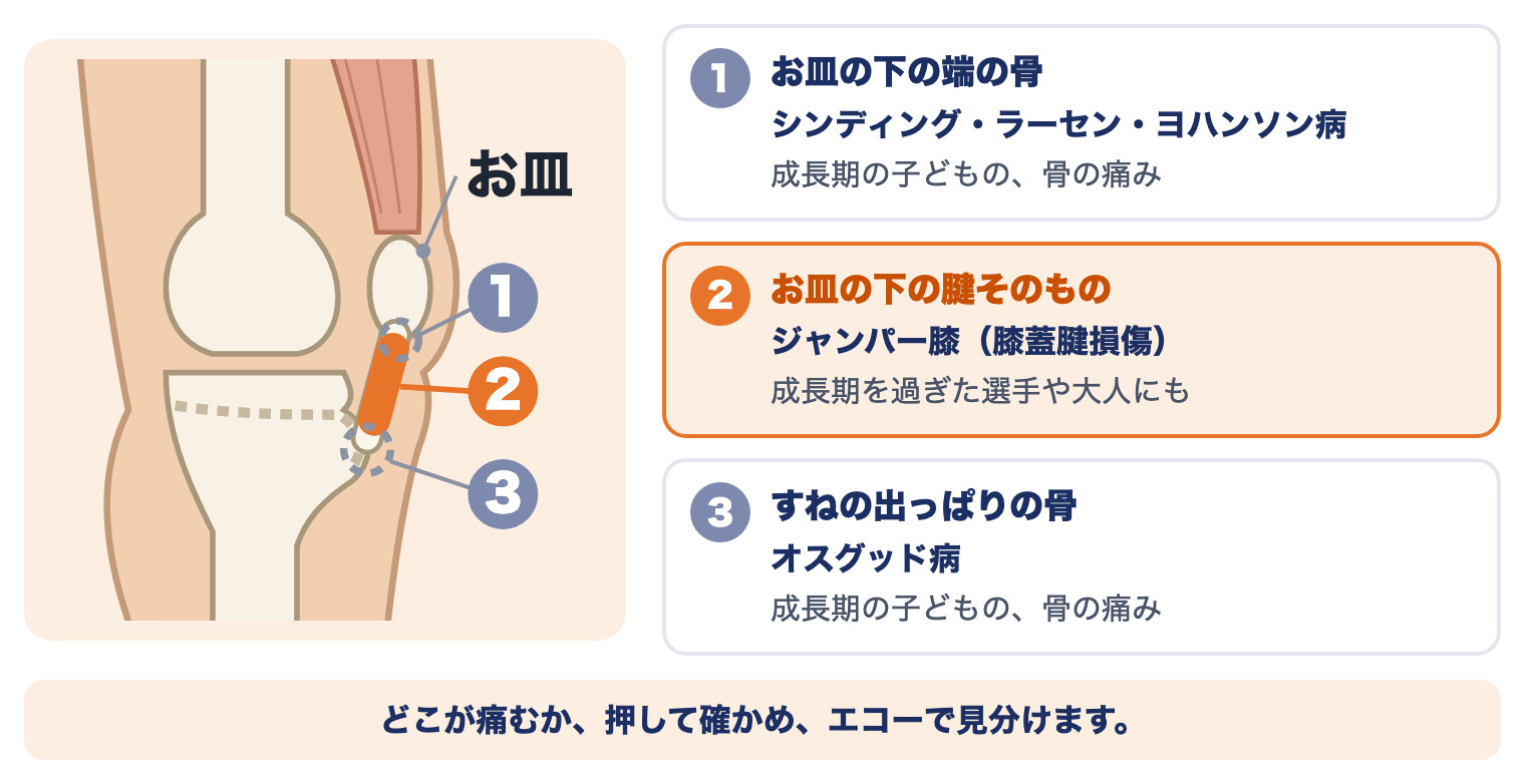 ジャンパー膝（膝蓋腱損傷）と痛む場所：お皿の下の端の骨（シンディング・ラーセン・ヨハンソン病）、お皿の下の腱（ジャンパー膝）、すねの出っぱりの骨（オスグッド病）