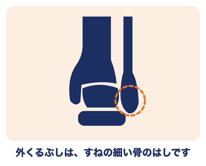 外果骨折とは：外くるぶしは、すねの細い骨（腓骨）のはし