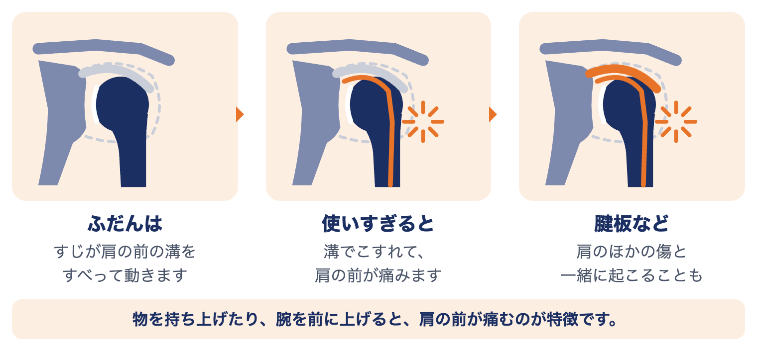 上腕二頭筋長頭腱炎で肩に起きていること：ふだんはすじが肩の前の溝をすべり、使いすぎると溝でこすれて痛み、腱板など肩のほかの傷と一緒に起こることもある