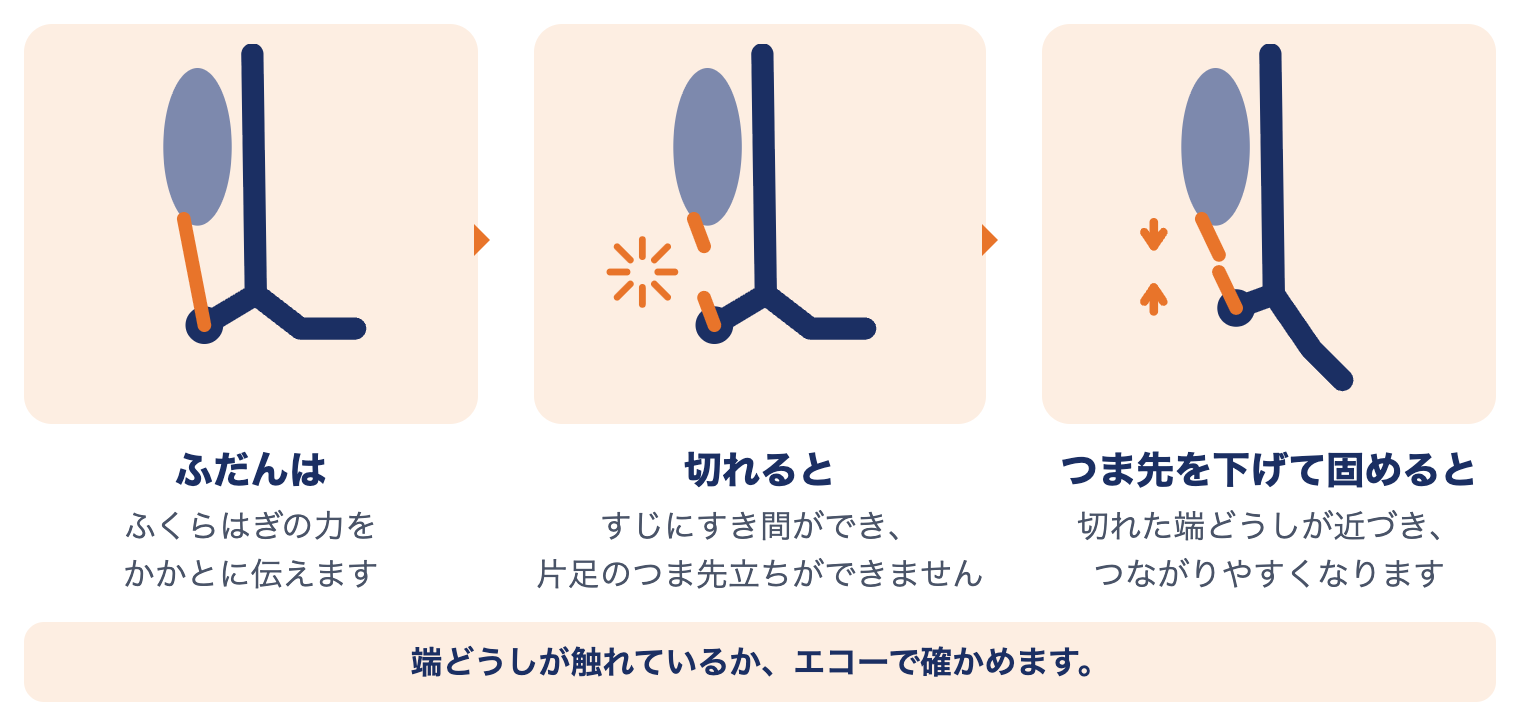 アキレス腱断裂で足の中で起きていること：ふだんはふくらはぎの力をかかとに伝え、切れるとすき間ができて片足のつま先立ちができず、つま先を下げて固めると端どうしが近づく