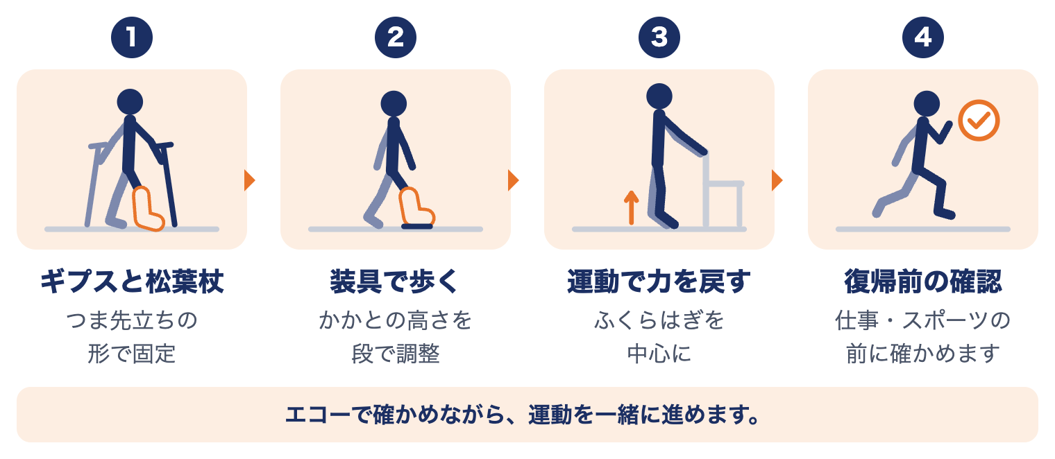 アキレス腱断裂のけがから復帰までの流れ：ギプスと松葉杖、装具で歩く、運動で力を戻す、復帰前の確認