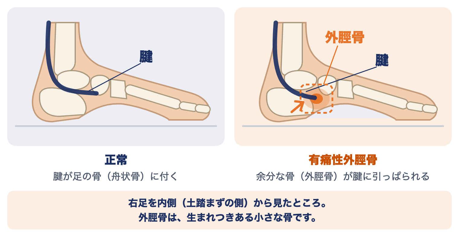 有痛性外脛骨の痛む場所：右足を内側から見た骨の絵で、正常では腱が足の骨（舟状骨）に付き、有痛性外脛骨では余分な骨（外脛骨）が腱に引っぱられて痛む様子