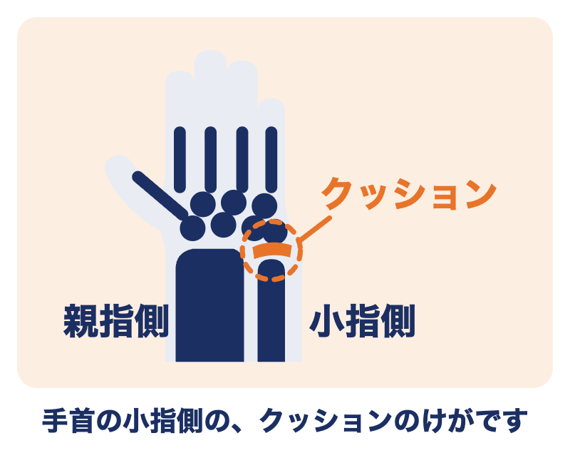 TFCC損傷の場所：手首の小指側にある、軟骨や靭帯でできたクッション