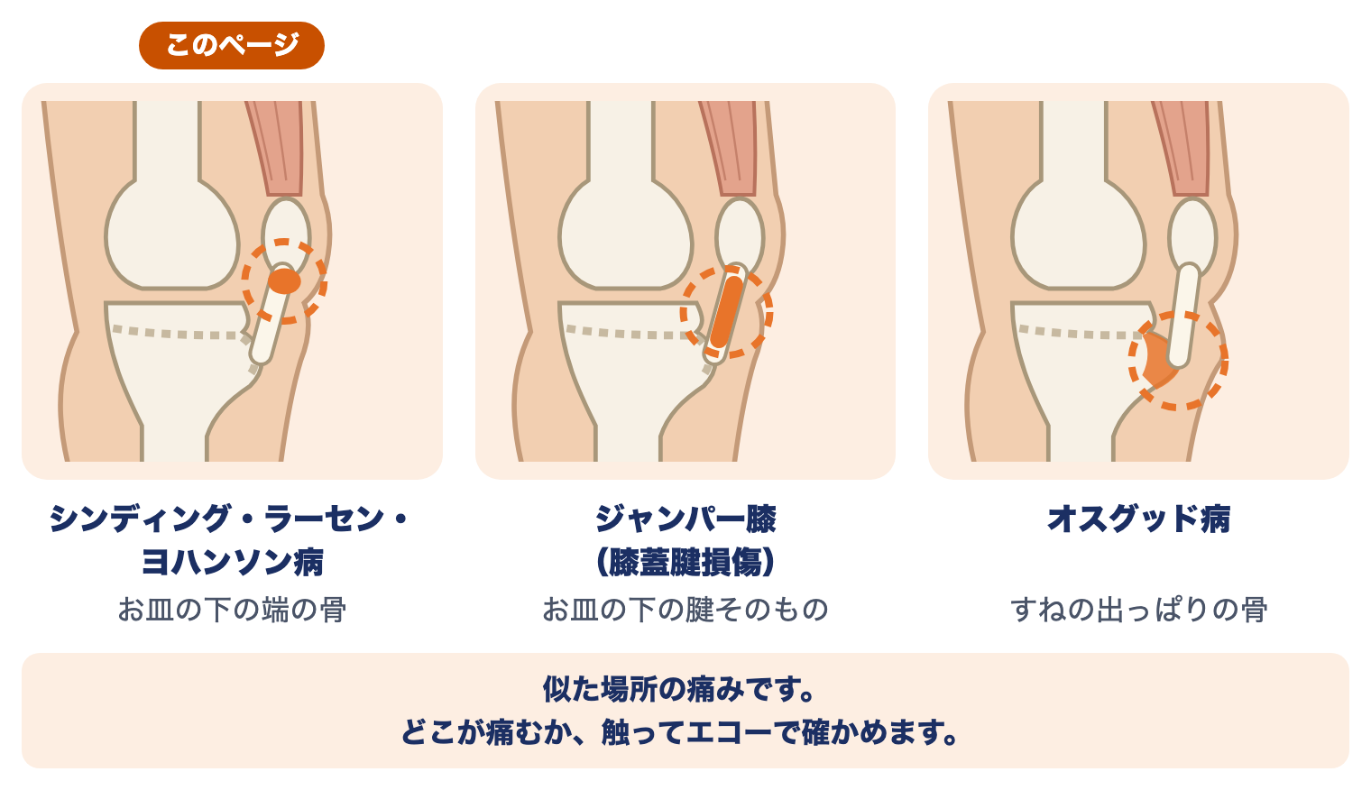 シンディング・ラーセン・ヨハンソン病の痛む場所：お皿の下の端の骨。ジャンパー膝はお皿の下の腱、オスグッド病はすねの出っぱりの骨