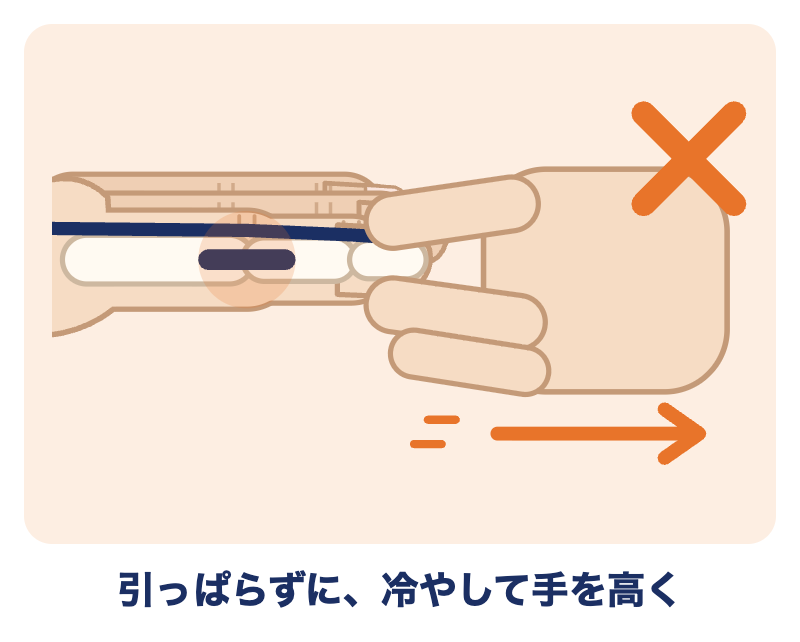 突き指をしたら、指を引っぱらずに、冷やして手を高くします
