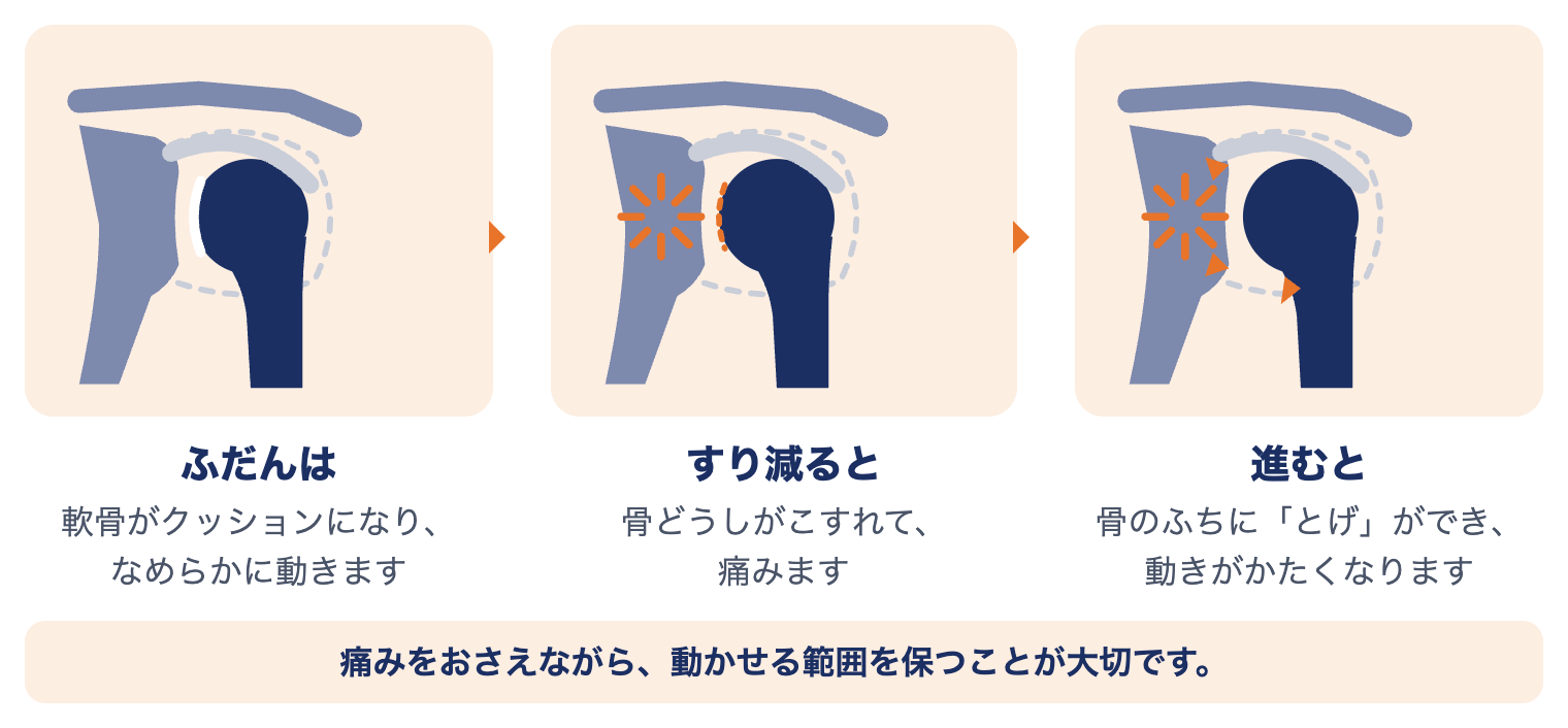 変形性肩関節症で肩に起きていること：ふだんは軟骨がクッションになり、すり減ると骨どうしがこすれて痛み、進むと骨のふちにとげができる