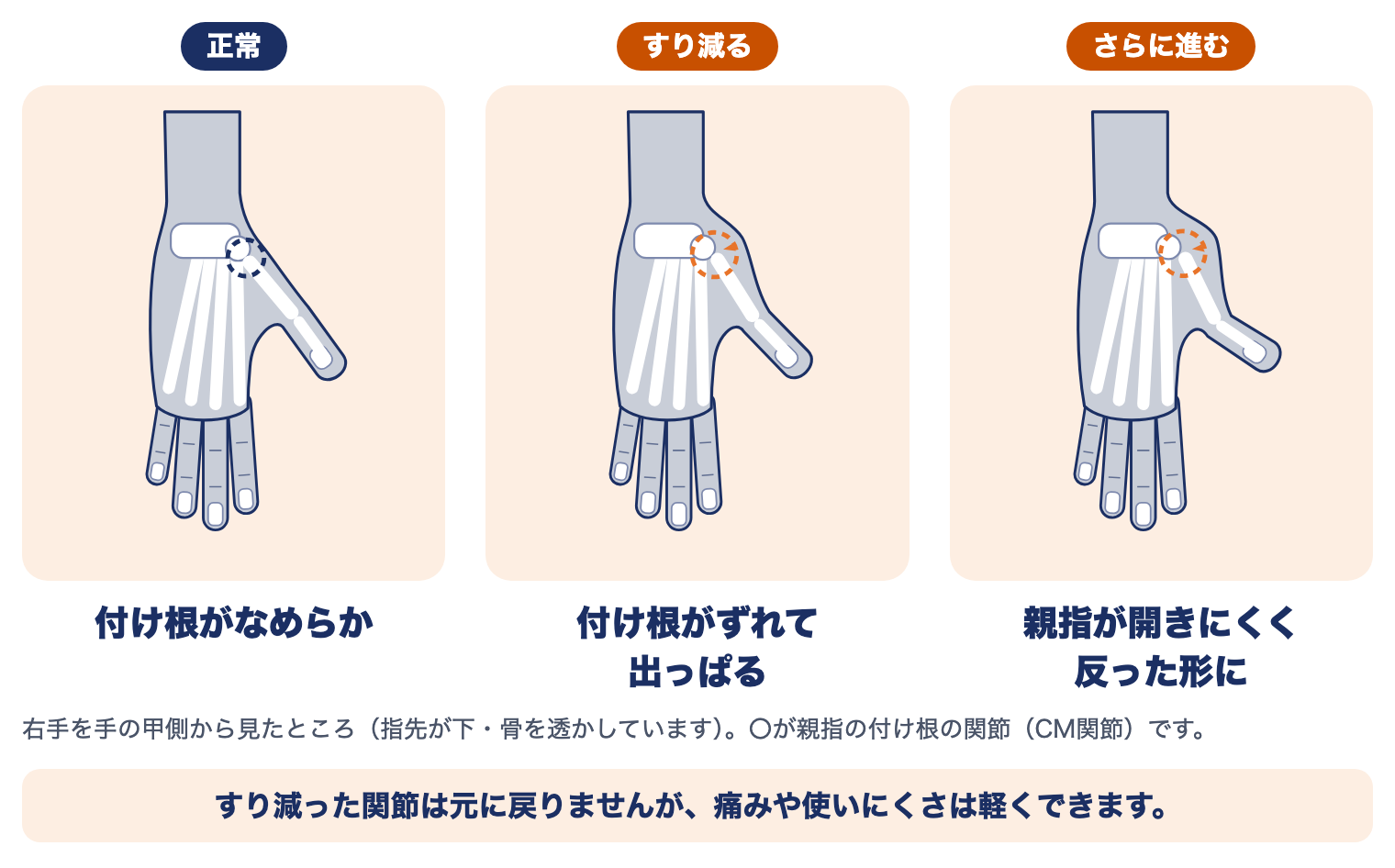 母指CM関節症の進み方：正常（付け根がなめらか）、すり減る（付け根がずれて出っぱる）、さらに進む（親指が開きにくく反った形に）