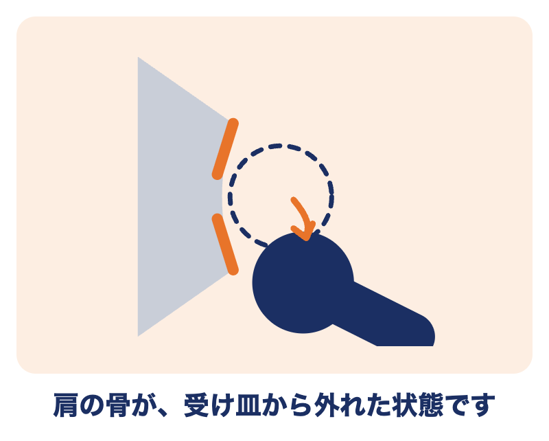 肩関節脱臼（肩が外れた状態）：肩の丸い骨が、受け皿から外れた状態の図