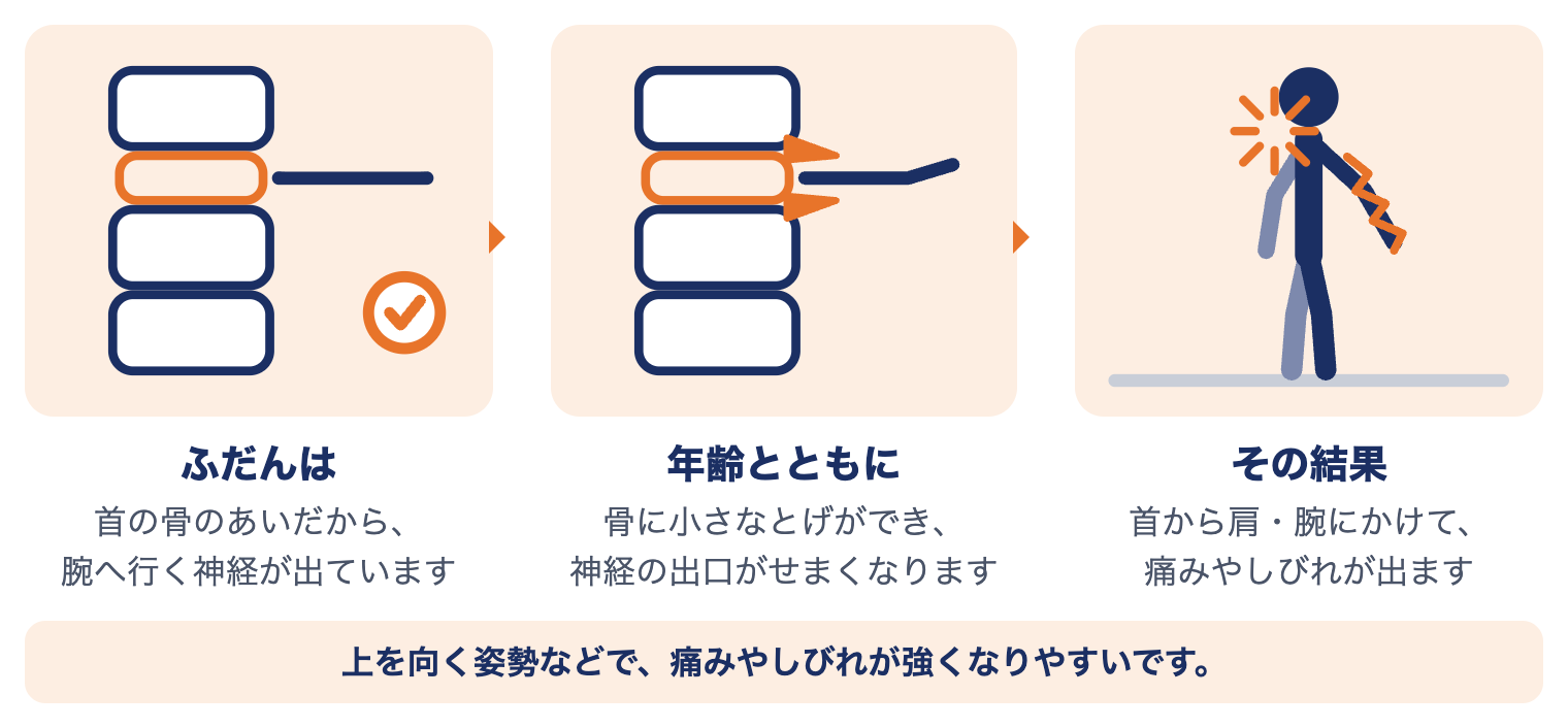 頚椎症性神経根症で首に起きていること：年齢とともに骨に小さなとげができ、腕へ行く神経の出口がせまくなり、首から肩・腕に痛みやしびれが出る